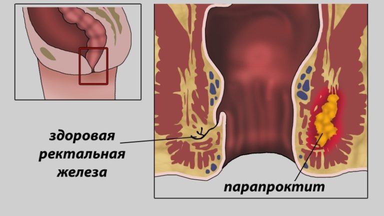 Острый парапроктит: Этиология, Патогенез, Классификация, Диагностика и Лечение