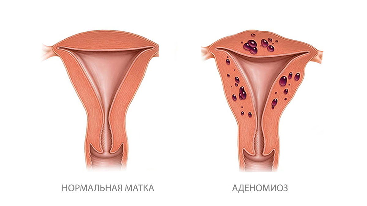 Аденомиоз: симптомы, причины и методы лечения