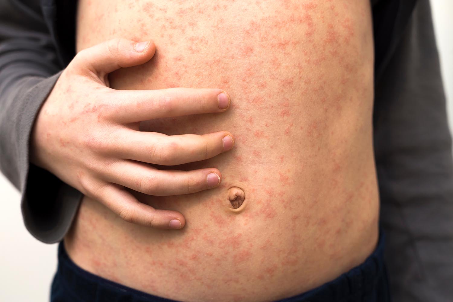 Всё о кори: симптомы, лечение, осложнения и вакцинация