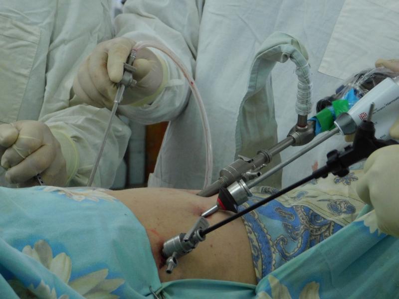 Видеоторакоскопическая хирургия: показания, методика и восстановление