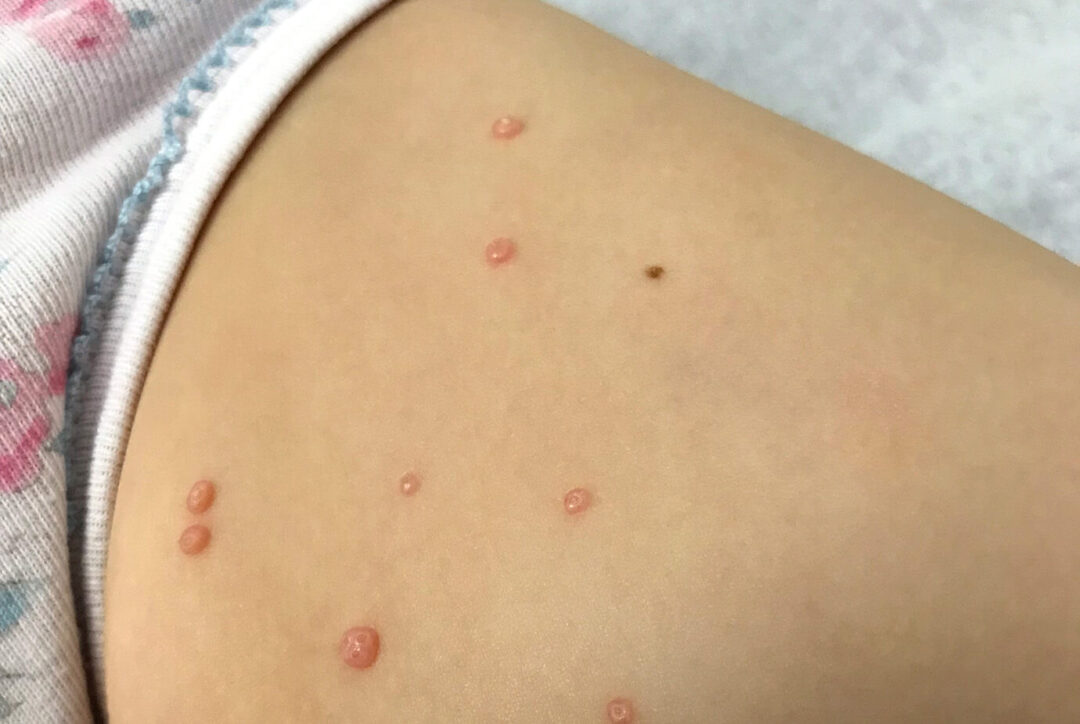 Контагиозный моллюск: полное руководство по симптомам, лечению и профилактике
