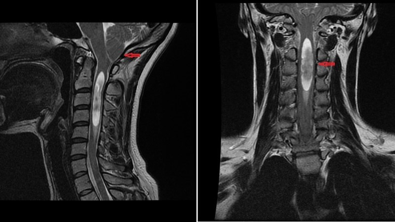 Аномалия Арнольда-Киари у детей: полное руководство для родителей по лечению