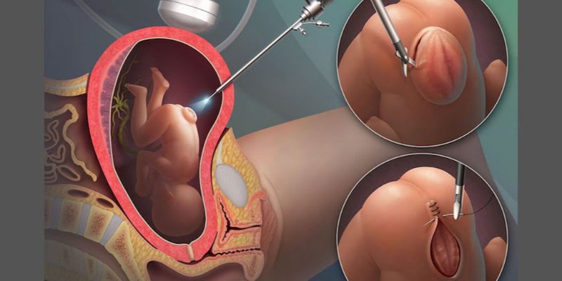 Spina bifida у детей: полное руководство по диагностике, лечению и жизни