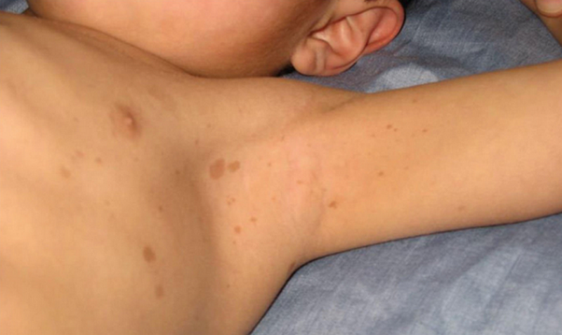 Нейрофиброматоз у ребенка: как понять диагноз и помочь своему малышу