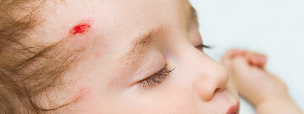 Сотрясение мозга у ребенка: полное руководство по симптомам и лечению