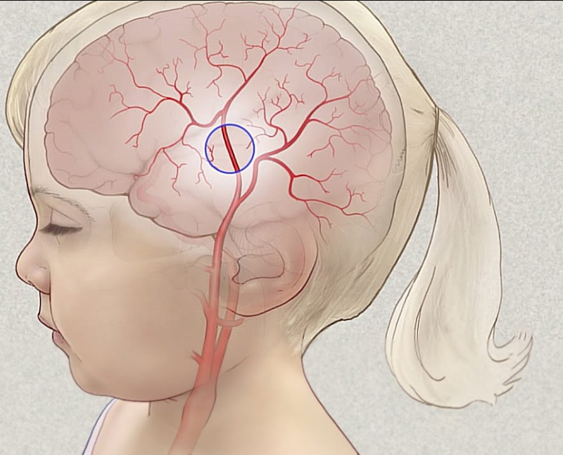 Болезнь моямоя у детей: полное руководство для родителей по диагностике и лечению