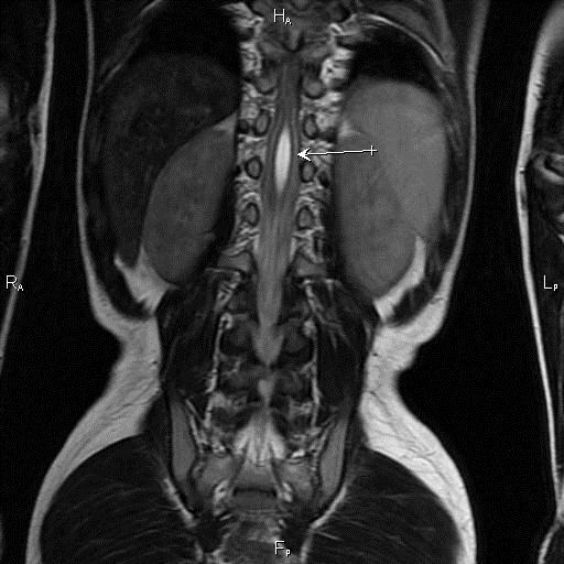 Сирингомиелия у детей: полное руководство по диагностике и лечению заболевания