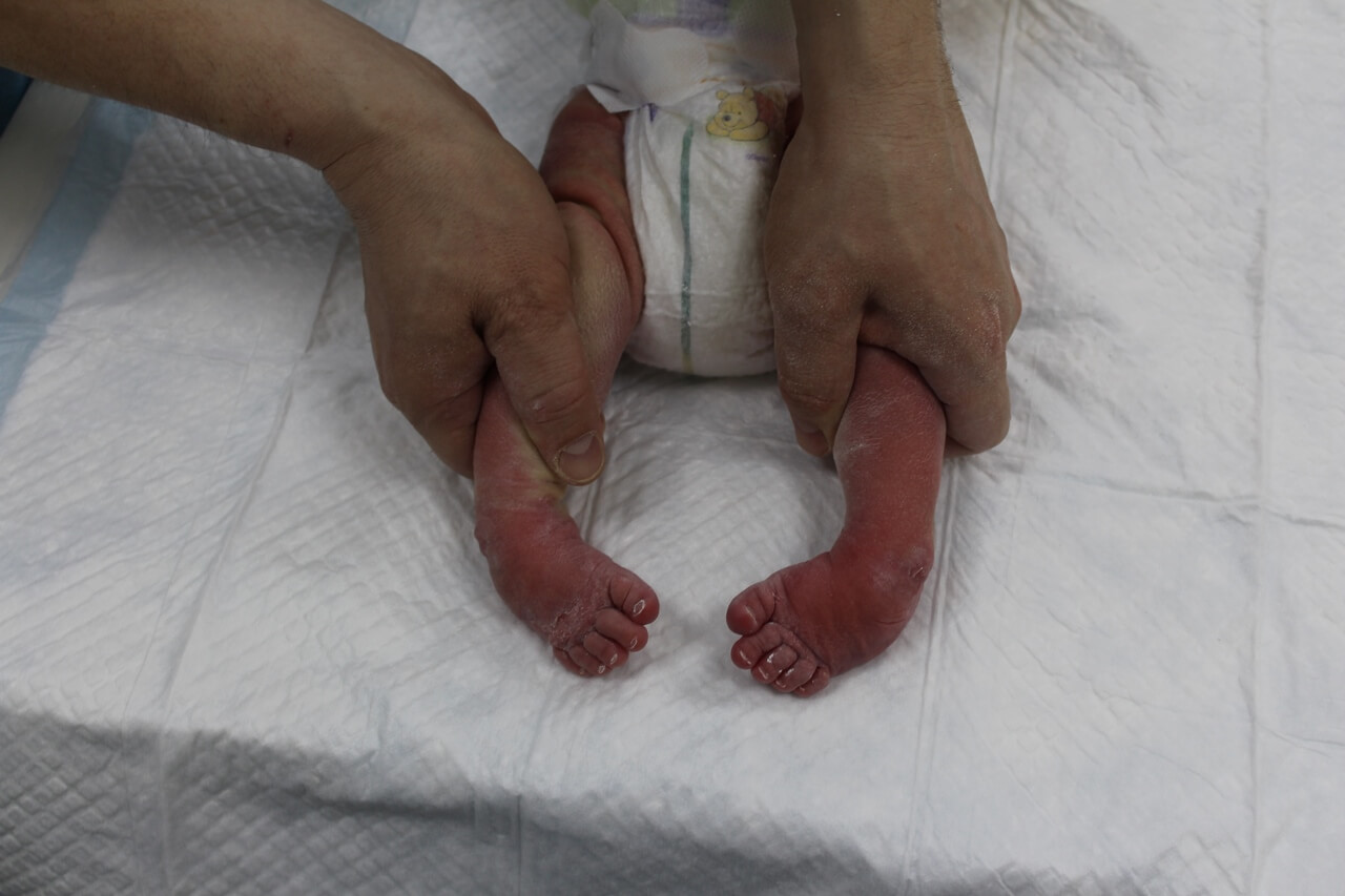 Врожденная косолапость у детей: полное руководство для родителей по лечению