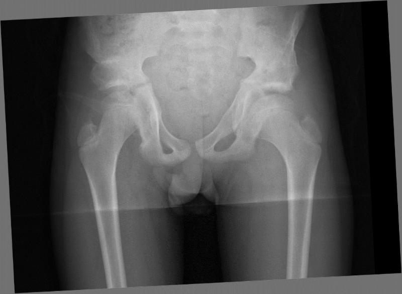 Болезнь Пертеса у детей: полное руководство для родителей по лечению и прогнозам