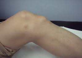 Болезнь Осгуда-Шлаттера у детей: полное руководство для родителей по лечению