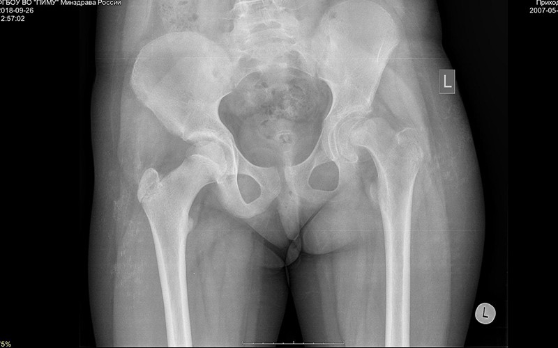 Юношеский эпифизеолиз головки бедренной кости: полное руководство для родителей