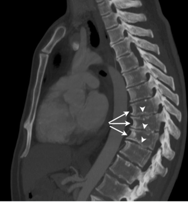 Болезнь Шейермана-Мау: как вовремя распознать и вылечить кифоз у подростка