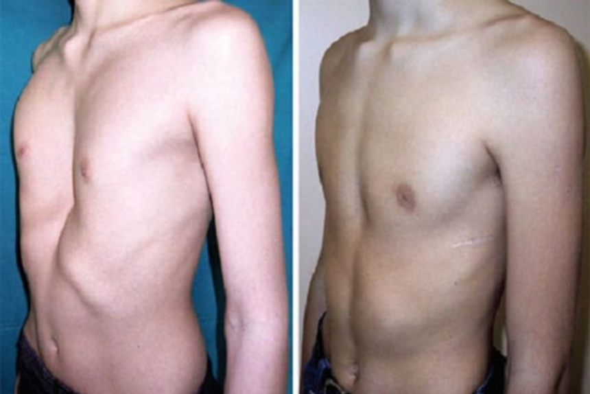 Рахитические деформации костей у детей: как вовремя заметить и вылечить