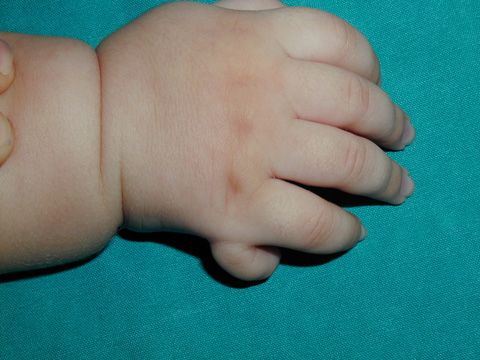 Полидактилия у детей: полное руководство по диагностике и лечению лишних пальцев