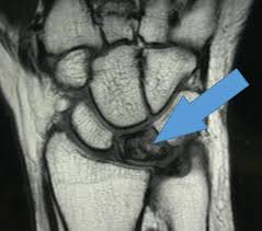 Болезнь Кинбека у подростков: от причин до полного восстановления функции кисти