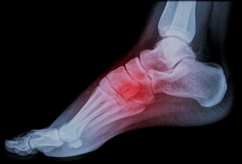 Болезнь Келера I у детей: как вернуть здоровье стопы и избежать осложнений