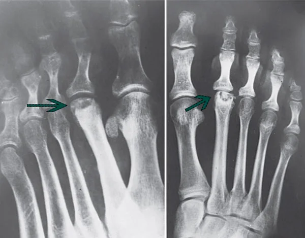 Болезнь Келера 2 типа у детей: найти причину боли и выбрать верное лечение
