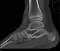 Тарзальная коалиция у детей: вернуть подвижность стопы и избавиться от боли