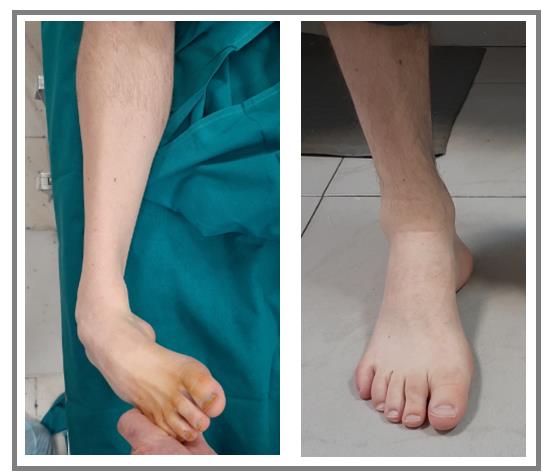 Полая стопа у ребенка: полное руководство по диагностике и лечению деформации