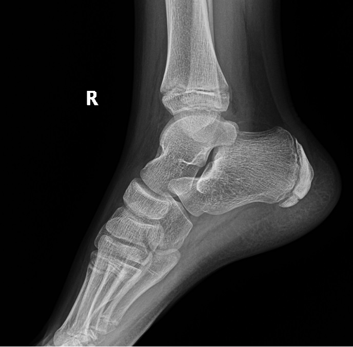 Болезнь Шинца у детей: найти причину боли в пятке и вернуться к активной жизни