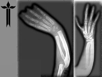 Врожденная локтевая косорукость у детей: полный гид по лечению и прогнозу
