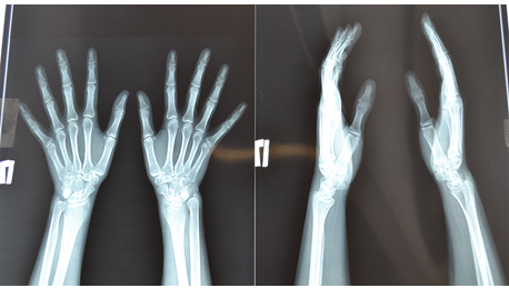 Болезнь Маделунга у детей: остановить деформацию и сохранить функцию сустава