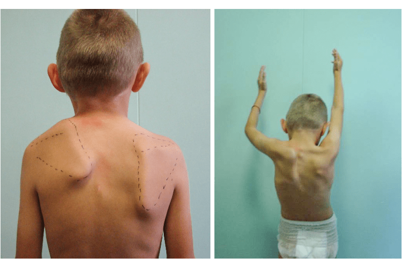 Болезнь Шпренгеля у детей: полное руководство по диагностике и лечению