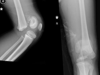 Перелом зоны роста у ребенка: полное руководство по диагностике и лечению