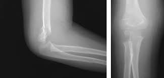 Надмыщелковый перелом плеча у ребенка: полное руководство для родителей