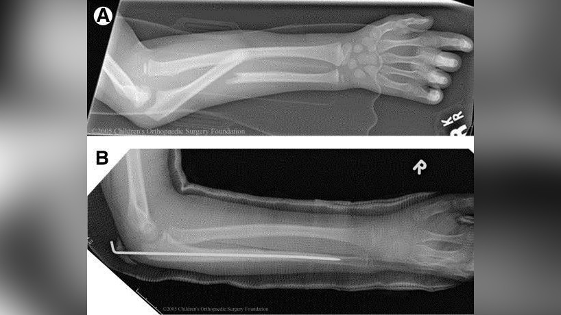 Перелом Монтеджа у ребенка: полное руководство по лечению и восстановлению