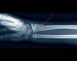 Перелом по типу зеленой ветки у детей: полное руководство для родителей