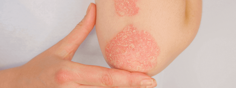 Ювенильный артрит у ребенка: сохранить здоровье суставов и полноценную жизнь