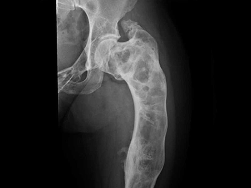 Фиброзная дисплазия у детей: причины, симптомы и современные методы лечения