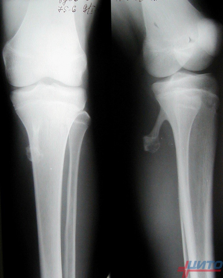 Костно-хрящевой экзостоз у детей: полное руководство для родителей