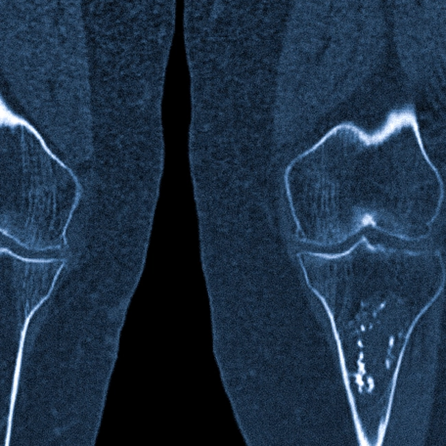 Энхондрома у ребенка: полное руководство для родителей по лечению и прогнозу
