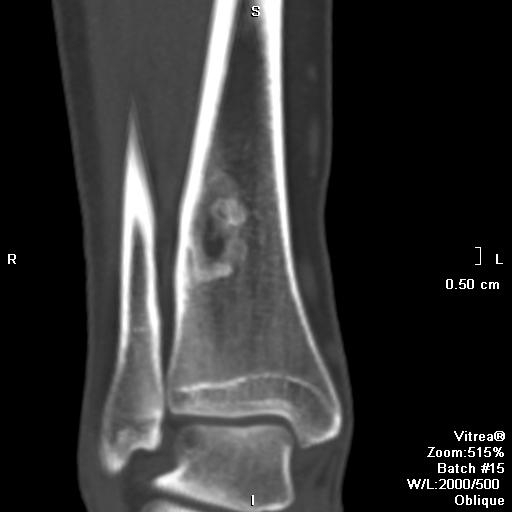 Неоссифицирующаяся фиброма кости у ребенка: полное руководство для родителей
