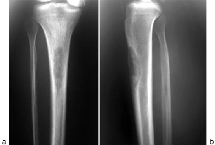 Простая костная киста у ребенка: найти и вылечить без последствий для роста