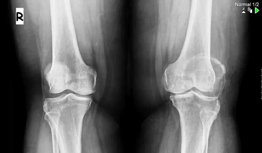 Аневризмальная костная киста у детей: от диагноза до полного восстановления