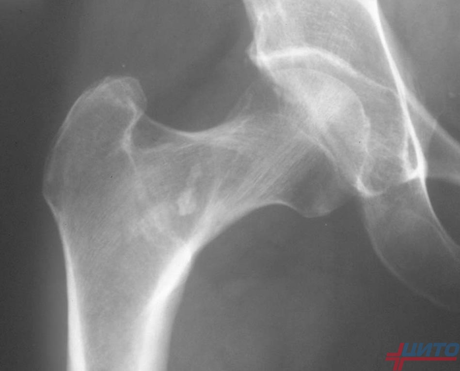 Остеоид-остеома у детей: полное руководство по диагностике и лечению