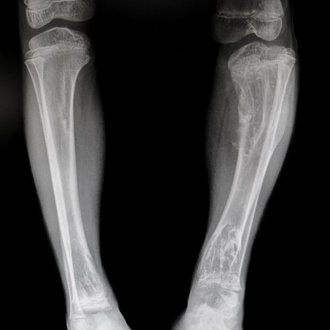 Костные дисплазии у детей: найти причину низкого роста и выбрать лечение
