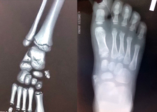 Добавочная ладьевидная кость у ребенка: полное руководство для родителей