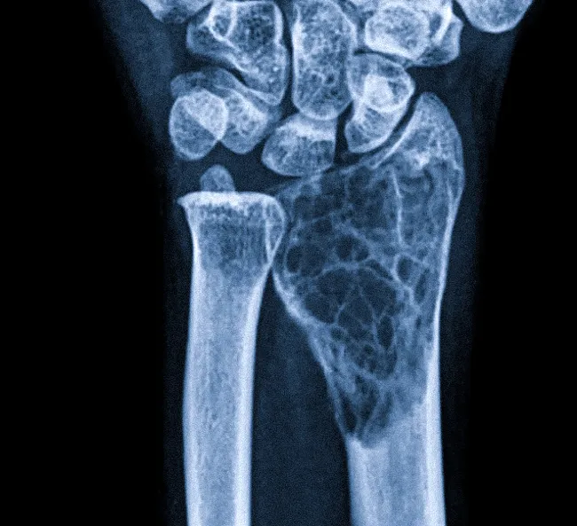 Гигантоклеточная опухоль кости у подростка: полный гид для родителей