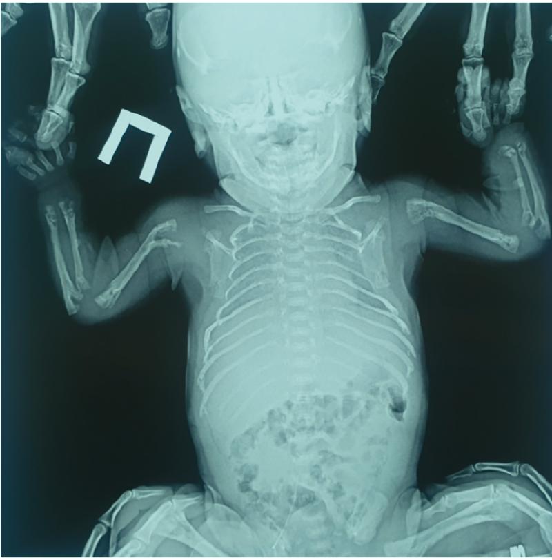 Врожденная гипоплазия костей у детей: найти решение для здоровья и роста