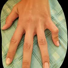 Камптодактилия у детей: полное руководство по лечению и восстановлению пальцев