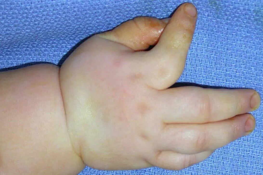 Клинодактилия у ребенка: обретение здоровых и ровных пальцев на руках