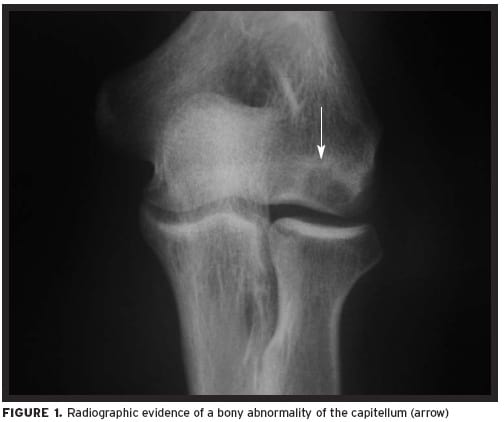 Болезнь Паннера у ребенка: полное руководство для родителей по лечению локтя