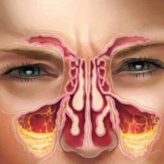 Сфеноидит у детей: полное руководство по диагностике и безопасному лечению