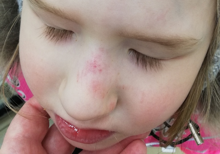 Травма носа у ребенка: полное руководство для родителей по лечению и уходу