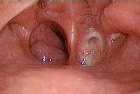 Атрезия хоан у новорожденных: полное руководство по диагностике и лечению