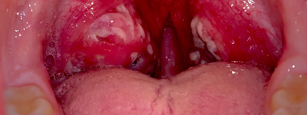 Острый фарингит у ребенка: вернуть комфорт и здоровье воспаленному горлу